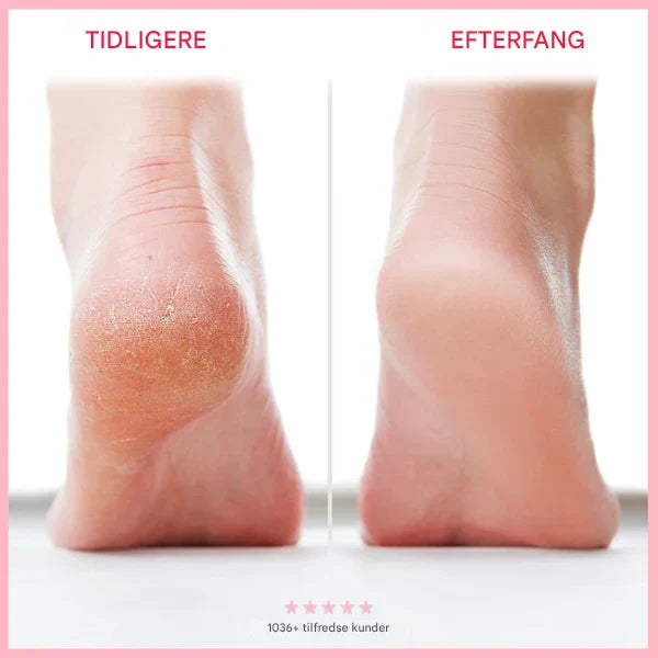 NovaGlow™ - Farvel til sprukken hud – goddag til bløde fødder!