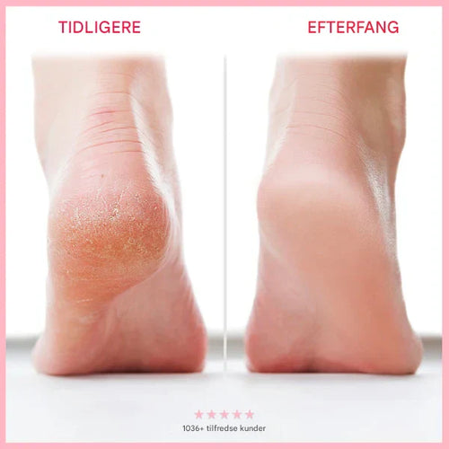 NovaGlow™ - Farvel til sprukken hud – goddag til bløde fødder!